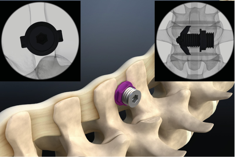 Minuteman G5 Fusion Plate – Modern Pain Consultants